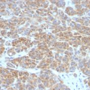FFPE human melanoma sections stained with 100 ul anti-Bcl-2 (clone BCL2/782) at 1:100. HIER epitope retrieval prior to staining was performed in 10mM Tris 1mM EDTA, pH 9.0.